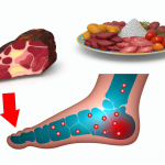 does smoked meat cause gout